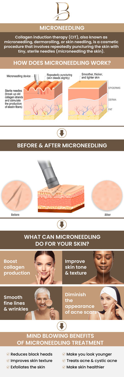 Microneedling is a highly effective, minimally invasive procedure that creates controlled micro-injuries in the skin, stimulating collagen and elastin production to visibly smooth the indented texture of acne scars. Consulting  Dr. Ngu Thien Nguyen, MD, and Dr. Marlin Lobaton, MD, is crucial, as they can accurately assess your specific scar type and overall skin health to ensure this treatment is safe and tailored to your complexion. By performing the procedure with medical-grade devices in a sterile, clinical environment, these experts maximize your skin's regenerative potential while drastically minimizing the risk of infection, hyperpigmentation, or further damage. For more information, contact us or request an appointment online. We are located at 1507 NE 150th St, Suite B, Shoreline, WA 98155.